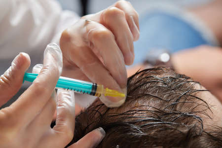 Injection plasma into head hair man cosmetologist doctor.の写真素材