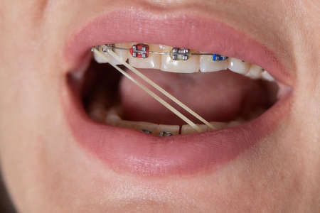 Closeup Braces on Teeth with Elastics. Orthodontic Treatment. Front View Dental Brackes.の写真素材