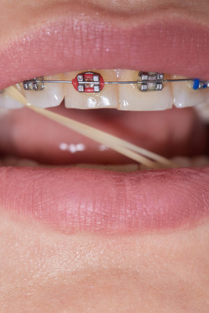 Closeup Braces on Teeth with Elastics. Orthodontic Treatment. Front View Dental Brackes.