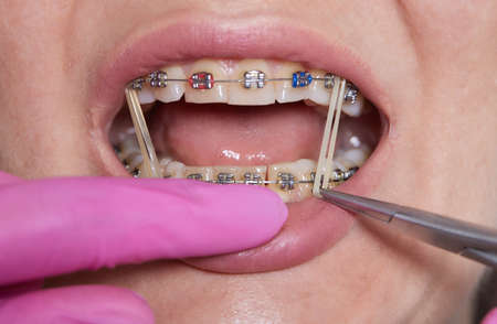 Closeup Braces on Teeth with Elastics. Orthodontic Treatment. Front View Dental Brackes.