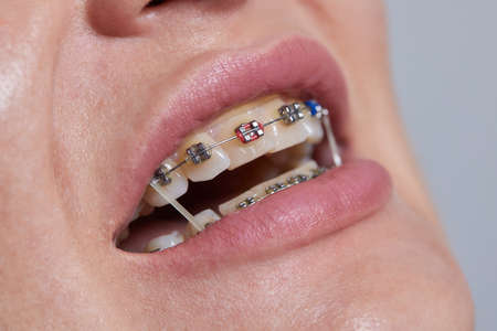 Closeup Braces on Teeth with Elastics. Orthodontic Treatment. Front View Dental Brackes.