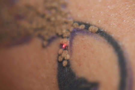 Young woman undergoing laser tattoo removal procedure in salon, closeup.の写真素材
