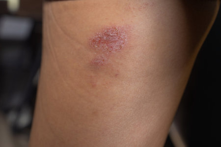 Abrasion on the womans knee. Injured leg with a red wound. Medical treatment for first aid.
