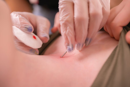 Operation to install microdermal piercing. Professional placingの写真素材