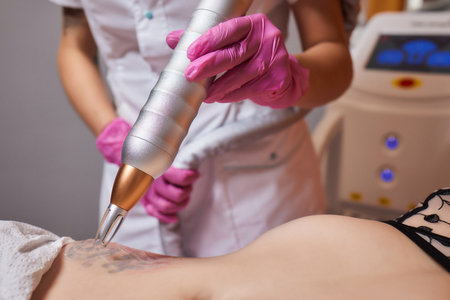 Young woman undergoing laser tattoo removal procedure in salon, closeup.の写真素材