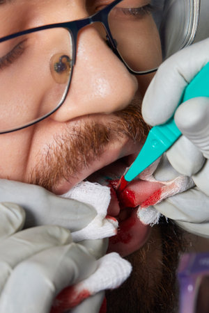 tongue splitting. cutting the tongue, one type of modification of the human body. surgery concept.の写真素材