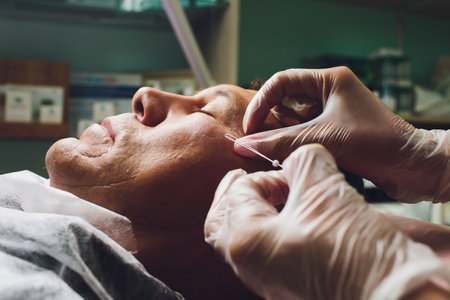 Close-up of procedure for face lifting PDO Suture operation, face lifting surgery. innovative technique of New thread lift, NovaThreads and Silhouette InstaLift mens bags under the eyes.の写真素材