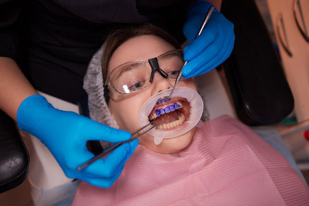 Plaque indicator on human teeth with braces. Plaque is colored pink. Teenager using plaque indicator gel. Teeth care.の写真素材