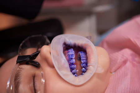 Plaque indicator on human teeth with braces. Plaque is colored pink. Teenager using plaque indicator...