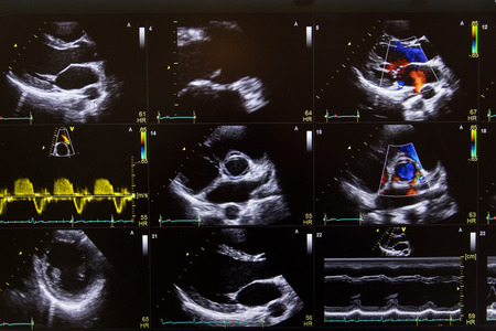 Heart ultrasound image on a computer screen.の写真素材