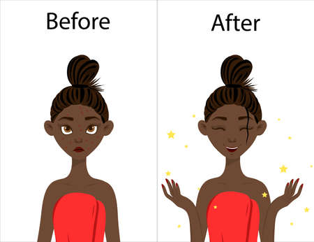 Dark-skinned girl before and after acne treatment. Cartoon style.のイラスト素材