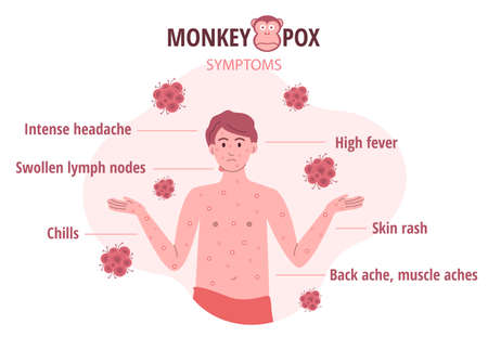 Monkey pox outbreak. Infographics of virus symptoms in humans. Vector illustration for informing people about an infectious diseaseのイラスト素材