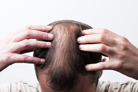 Close-up balding head of a young man on a white isolated background.