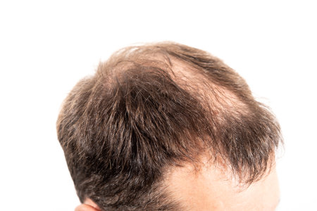 Close-up balding head of a young man on a white isolated background.の写真素材