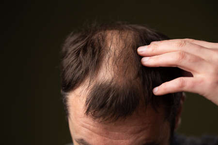 A man with baldness on a dark background head close-up.の写真素材