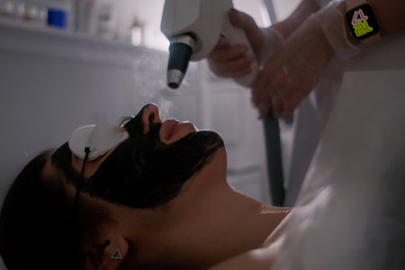 A woman is undergoing a carbon laser facial treatment. Her face is covered with a black carbon mask, protective goggles shield her eyes.の写真素材