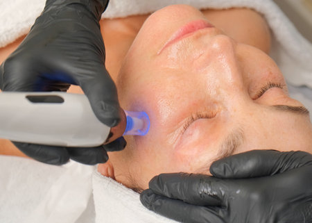 Close-up portrait of a beautiful aged woman during microneedling with dermapen from a beautician.の写真素材