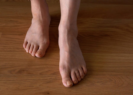 Close-up of a woman s foot with hallux valgus bunion and signs of toenail fungus. Her hand gently...