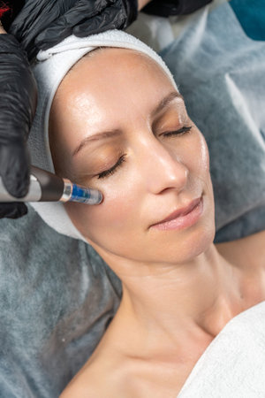 Woman having an aesthetic microneedling dermapen procedure for skin rejuvenation