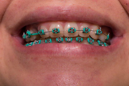 TEETH OF YOUNG WOMAN WITH ORTHODONTIC TREATMENT AND AQUA BLUE BRACES