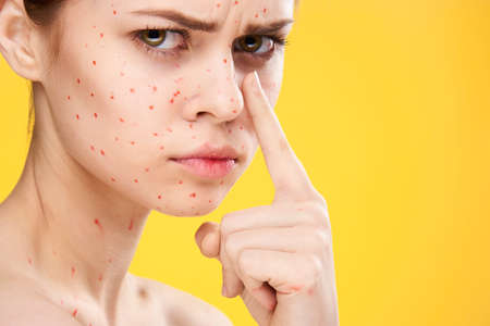 woman with red dots on her face skin problems dermatology dissatisfactionの写真素材