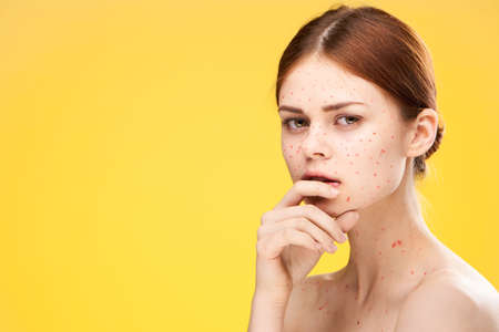 woman with bare shoulders red dots on her face health problems dermatologyの写真素材