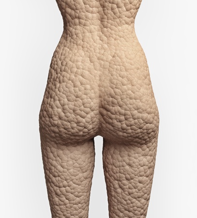 cellulite texture on the human skin  illustrationconcept の写真素材
