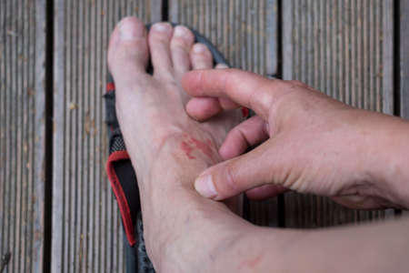 A hand itching chafed bare foot taken out of slipperyの写真素材