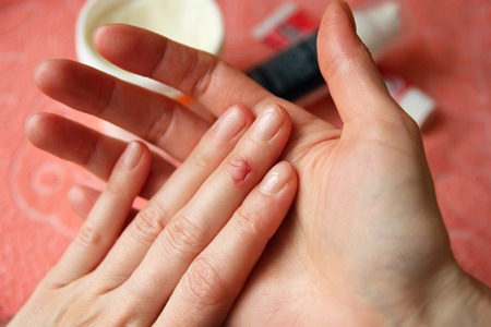 The cut on his finger female handの写真素材