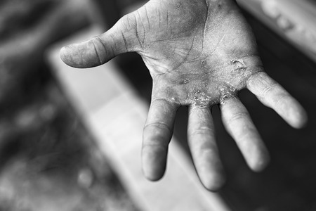 Palm with Calluses. Hard Work Concept. Blisters on the Injured Hand From Manual Work.の写真素材