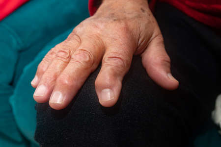 Hand of elderly person with osteoarthritis