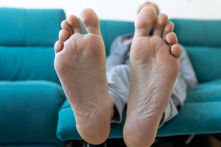 Blisters on the foot of a Caucasian man sitting on the couch