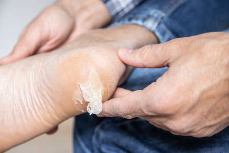 Broken and dry blister skin on the footの写真素材