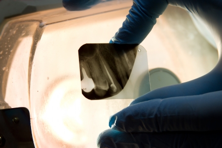 Panoramic dental X-Ray in hand.