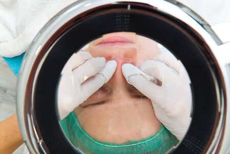 Beautician removes - squeezes acne from the face of a young beautiful girl. The concept of cosmetology. The cosmetologist performs the procedure to cleanse the face with problem skin. under cosmetic magnifying glass.の写真素材