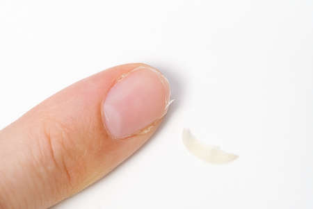 broken nail on a womans hand. close-up of a broken nail. brittle fingernail due to lack of vitamins in the bodyの写真素材