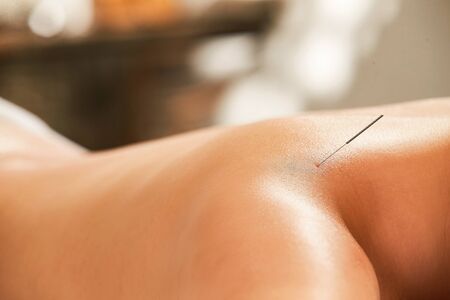 Patient undergoing acupuncture treatmentの写真素材