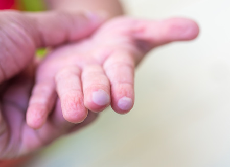 blister on children finger caused by hot water injuryの写真素材