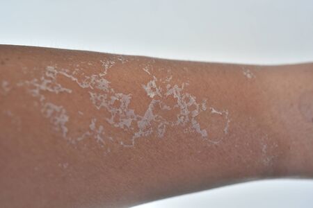 dry skin peeling after sun burnedの写真素材