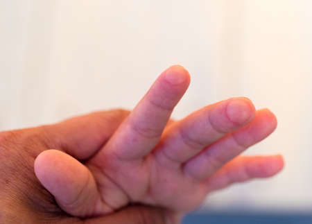 blister on children finger caused by hot water injuryの写真素材