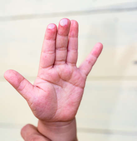 blister on children finger caused by hot water injuryの写真素材