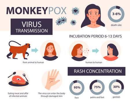 onkey pox virus symptoms infographic. It cause skin infections. Headache, fever, rash in the patient. Flat vector illustration.のイラスト素材