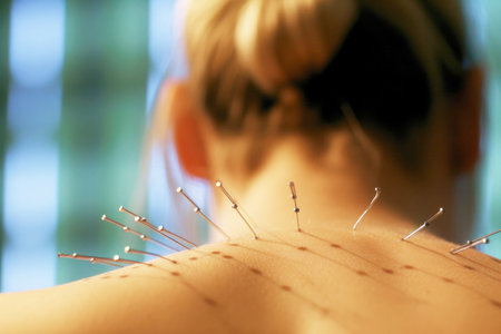 Acupuncture procedure on the back of a young woman. traditional chinese medicine.の素材