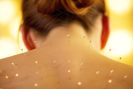Steel needles on the back of a young woman. Acupuncture treatment.の素材