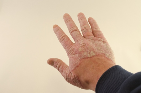 exacerbation of psoriasis in the handsの写真素材