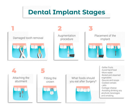 Vector illustration with a brochure, leaflet or poster with a Memo and Recommendations for Patients undergoing Dental Implantation at the Dentist. The sequence and Steps of Implantation are shown.のイラスト素材