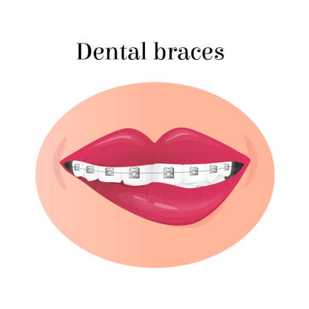 Vector image of mouth with teeth in dental braces.のイラスト素材