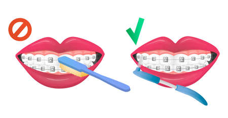 Vector isolated image of instructions to rule of right and false brush teeth with dental braces, retainer. Concept tooth care, braces and chosen toothbrush. You can be used in web design, postcard, etcのイラスト素材