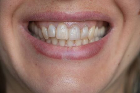 female teeth on a blurred background