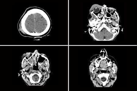 computed tomography of the brain with a fracture of the frontal part of the skull after receiving an injury, a reversal of the skull of the head after falling off a bicycleの写真素材